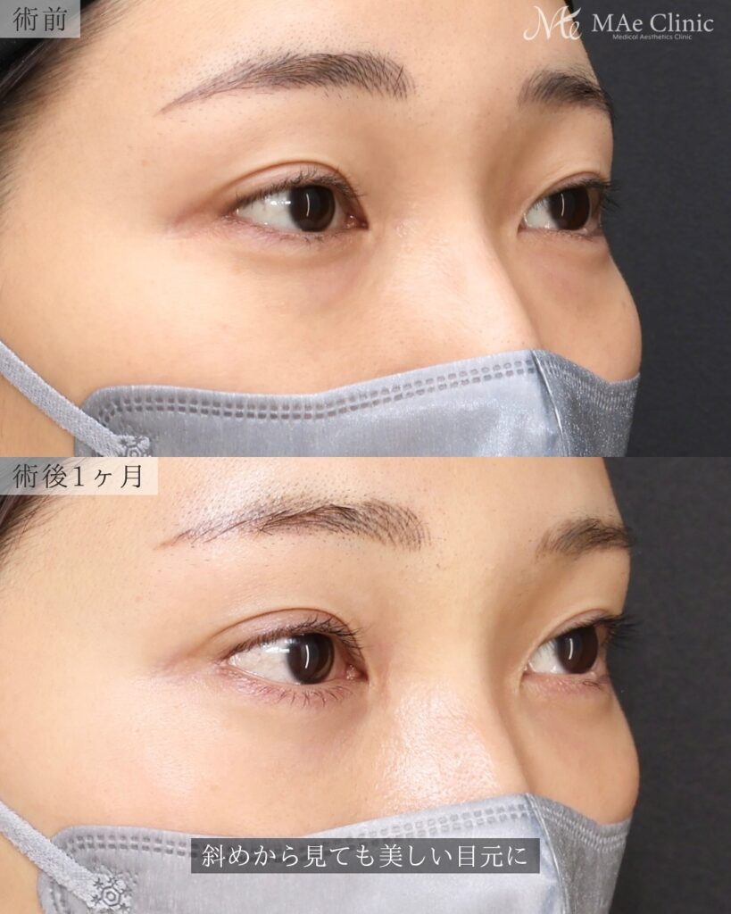 裏ハムラ法(経結膜下眼瞼形成術) 埋没法修正 前之園健太医師症例