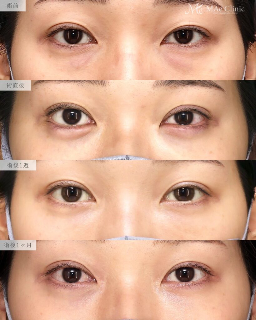 裏ハムラ法(経結膜下眼瞼形成術) 埋没法修正 前之園健太医師症例