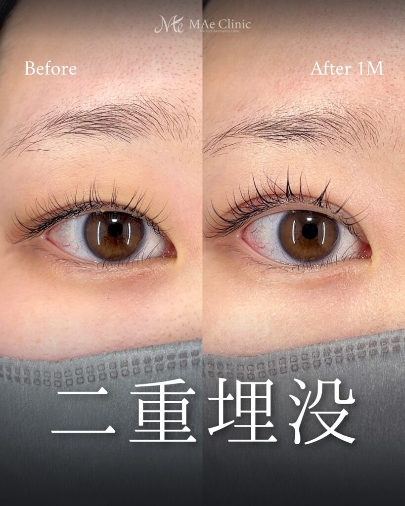 二重埋没法(裏留め2ループ)術後1ヵ月 前之園健太医師症例