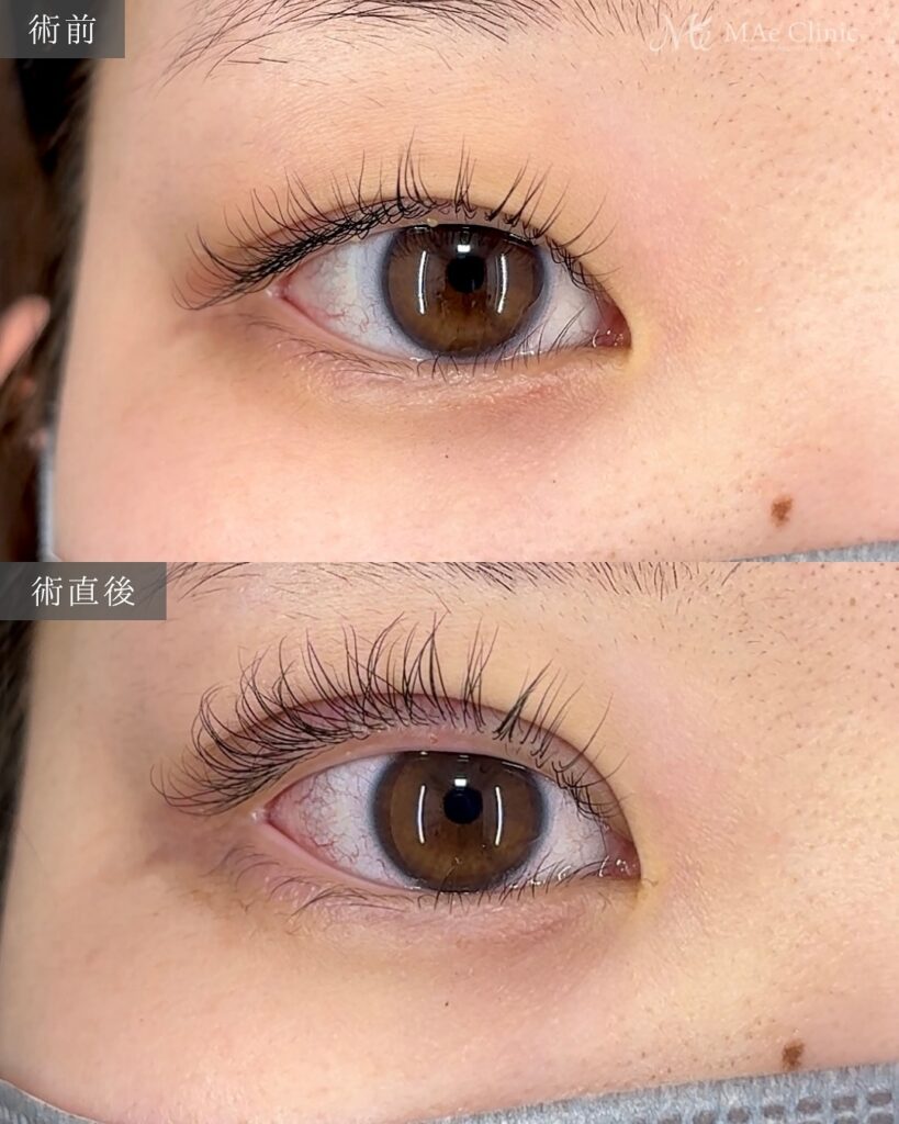 二重埋没法(裏留め2ループ)術後1ヵ月 前之園健太医師症例