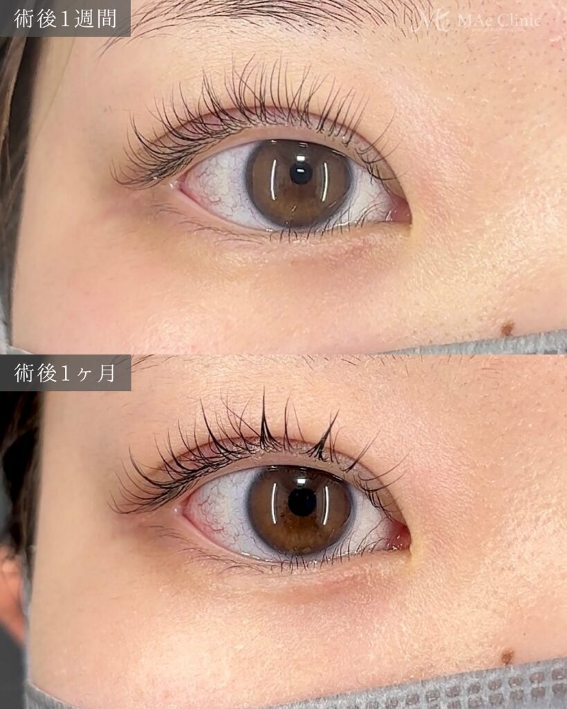 二重埋没法(裏留め2ループ)術後1ヵ月 前之園健太医師症例