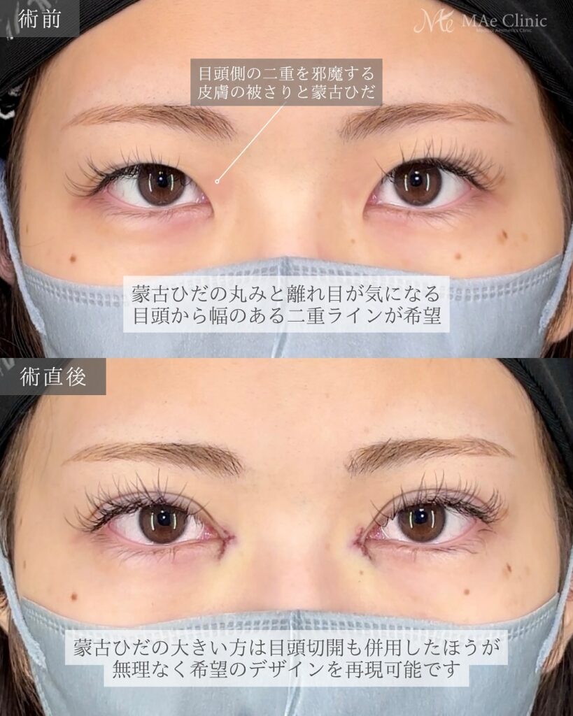 目頭切開(Z法)+二重埋没法(裏留め) 前之園健太医師症例