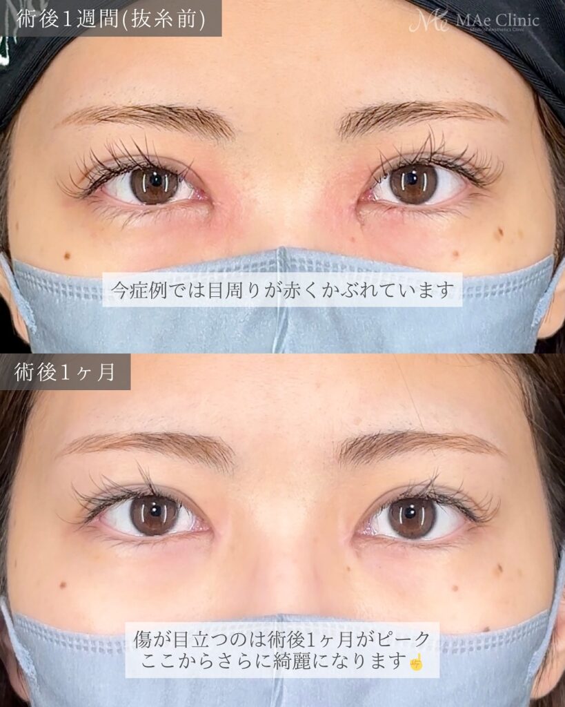 目頭切開(Z法)+二重埋没法(裏留め) 前之園健太医師症例