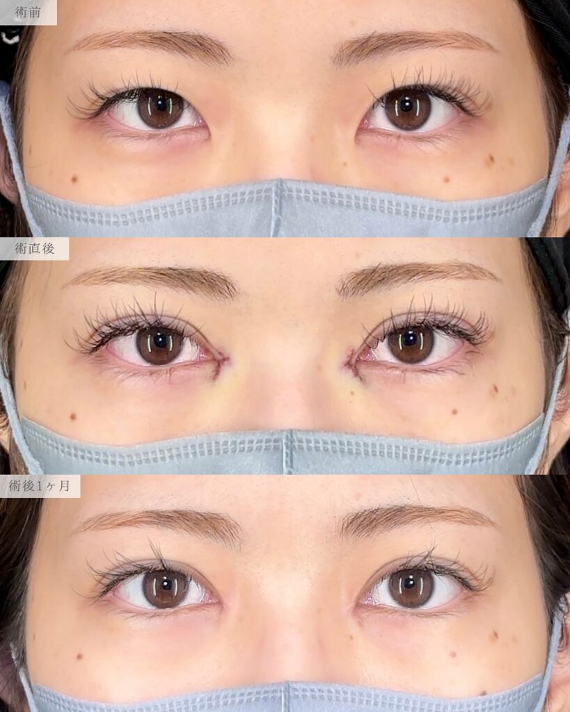 目頭切開(Z法)+二重埋没法(裏留め) 前之園健太医師症例