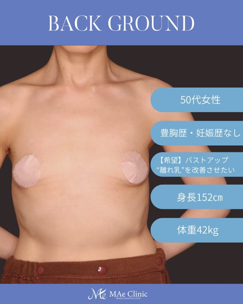 コンデンスリッチ脂肪豊胸 術後6ヵ月症例写真 木下恵里沙医師