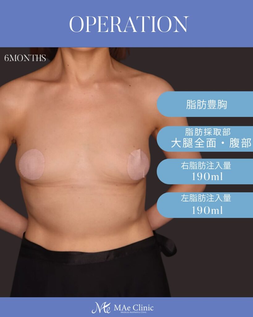 コンデンスリッチ脂肪豊胸 術後6ヵ月症例写真 木下恵里沙医師