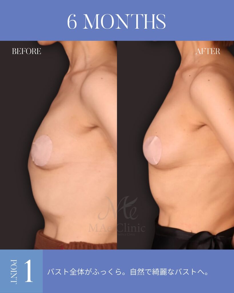 コンデンスリッチ脂肪豊胸 術後6ヵ月症例写真 木下恵里沙医師