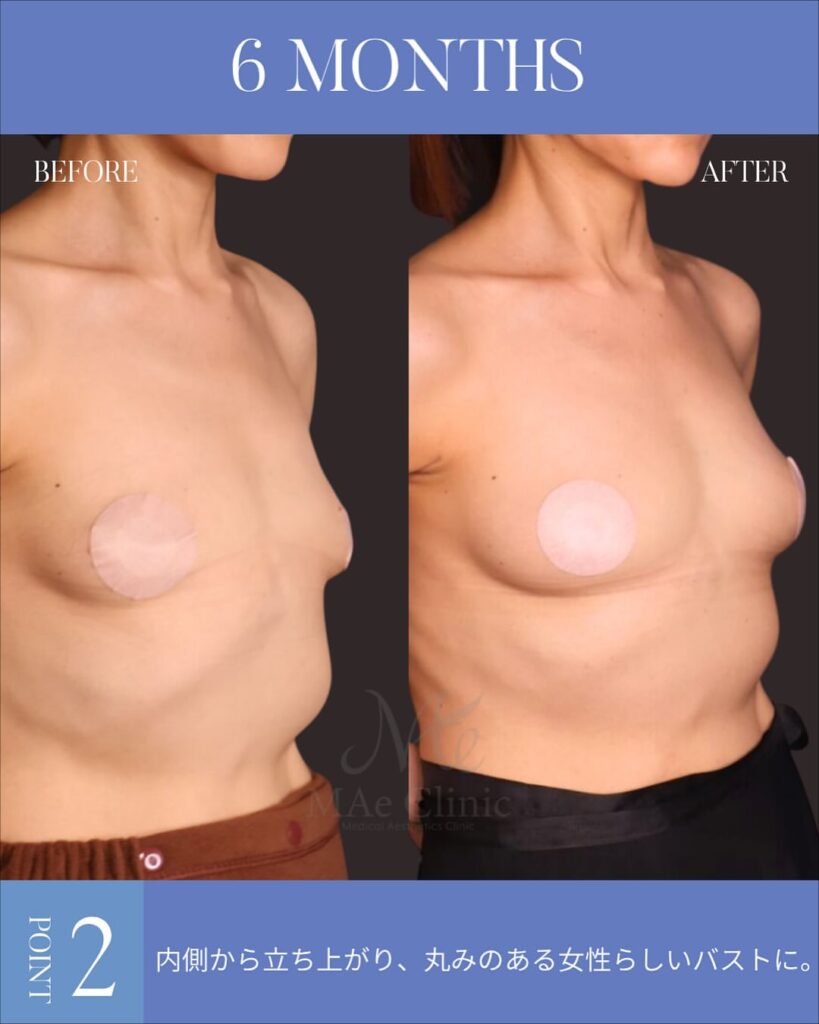 コンデンスリッチ脂肪豊胸 術後6ヵ月症例写真 木下恵里沙医師