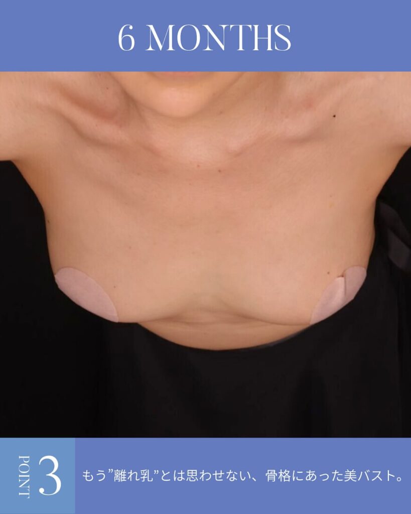 コンデンスリッチ脂肪豊胸 術後6ヵ月症例写真 木下恵里沙医師