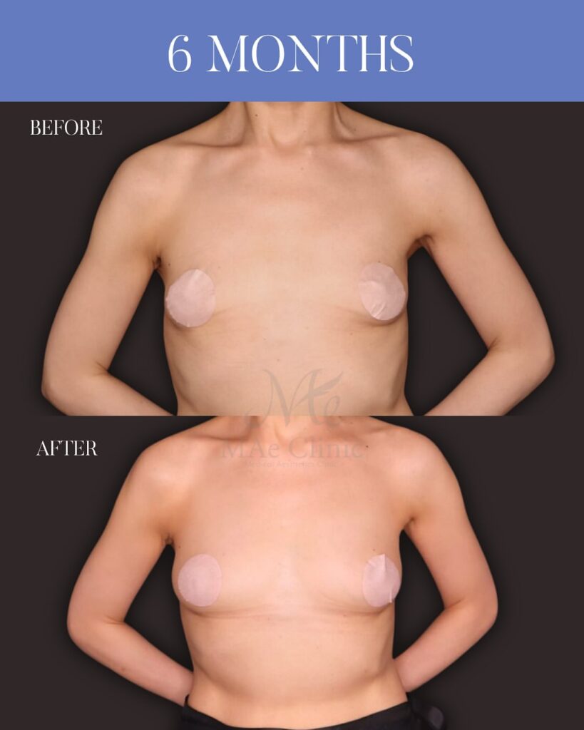 コンデンスリッチ脂肪豊胸 術後6ヵ月症例写真 木下恵里沙医師