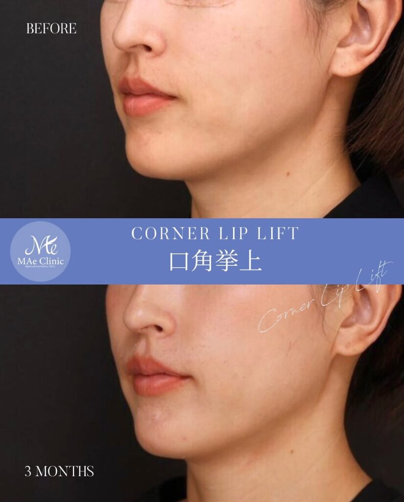 口角挙上術
木下恵里沙医師症例写真