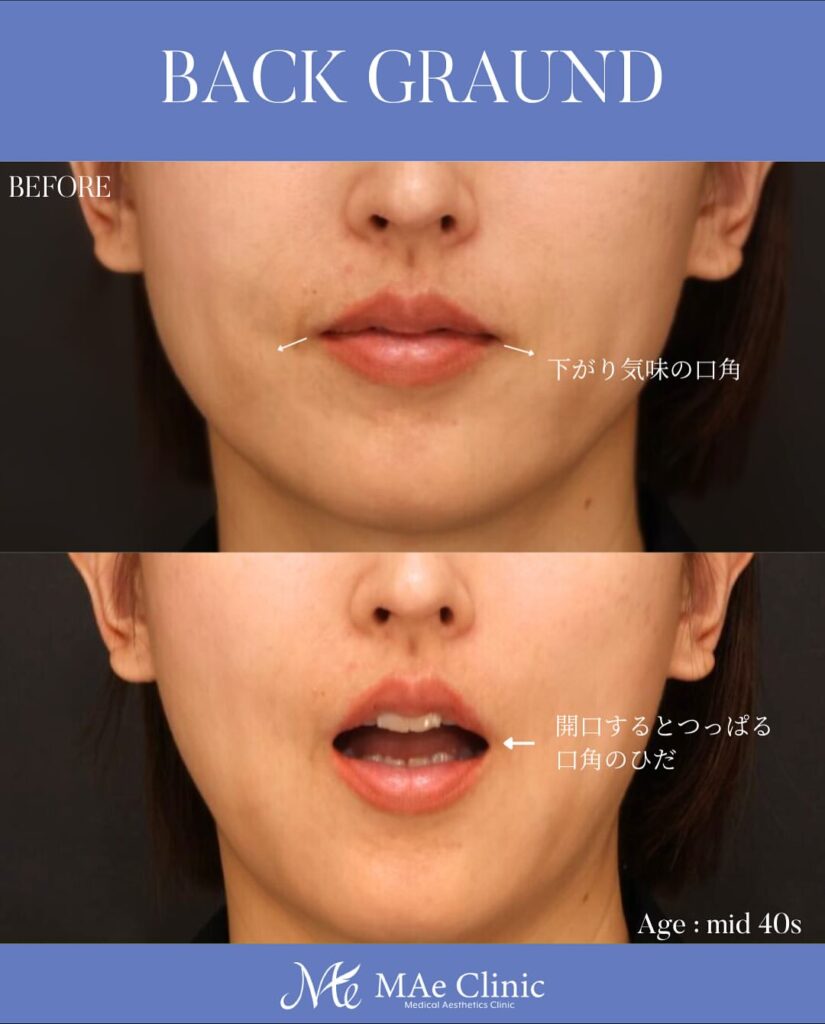 口角挙上術 木下恵里沙医師症例写真