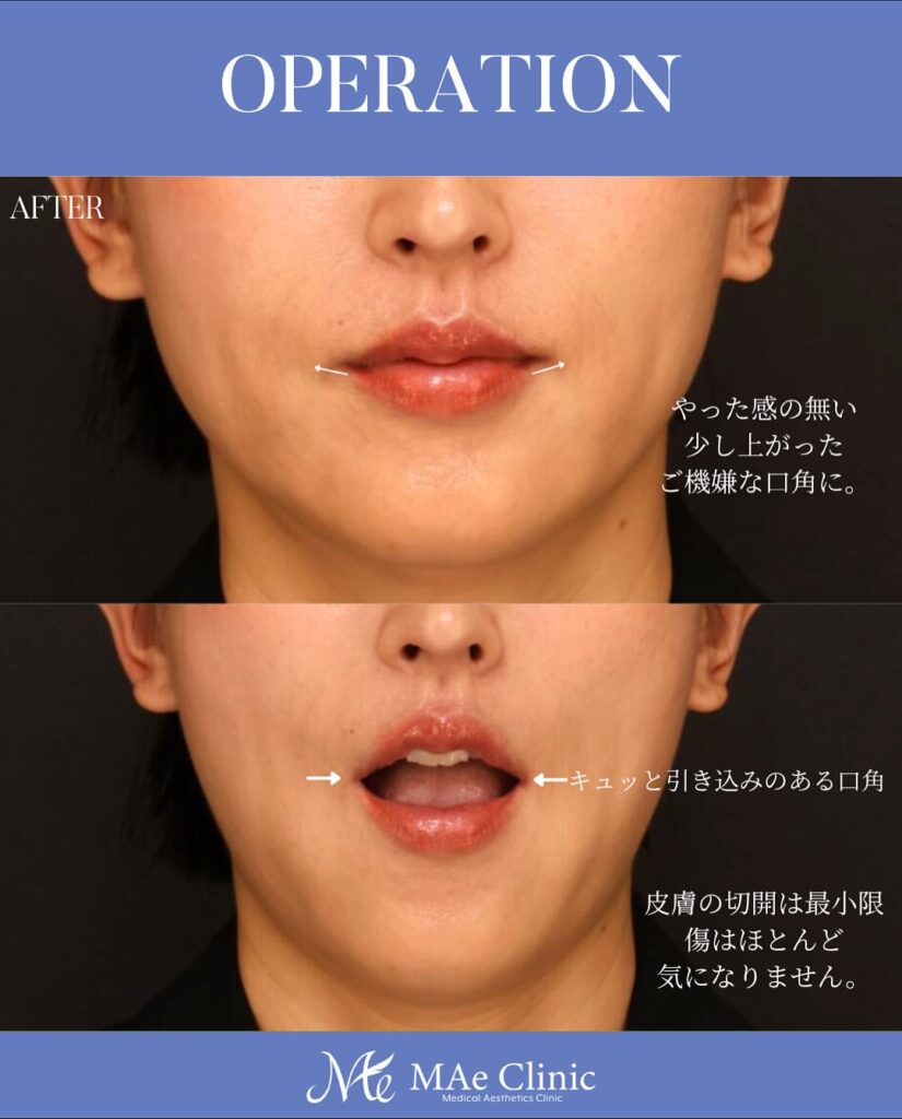 口角挙上術 木下恵里沙医師症例写真