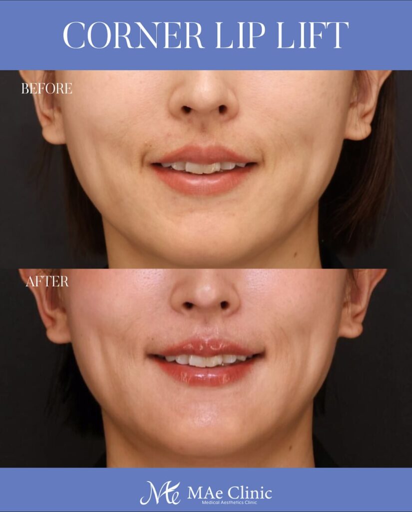 口角挙上術 木下恵里沙医師症例写真