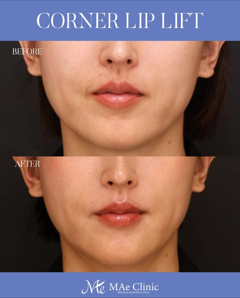 口角挙上術 木下恵里沙医師症例写真