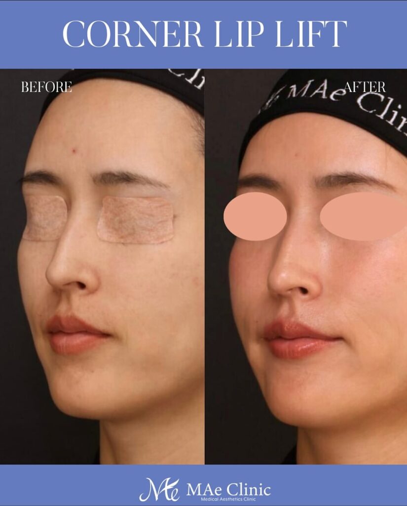 口角挙上術 木下恵里沙医師症例写真