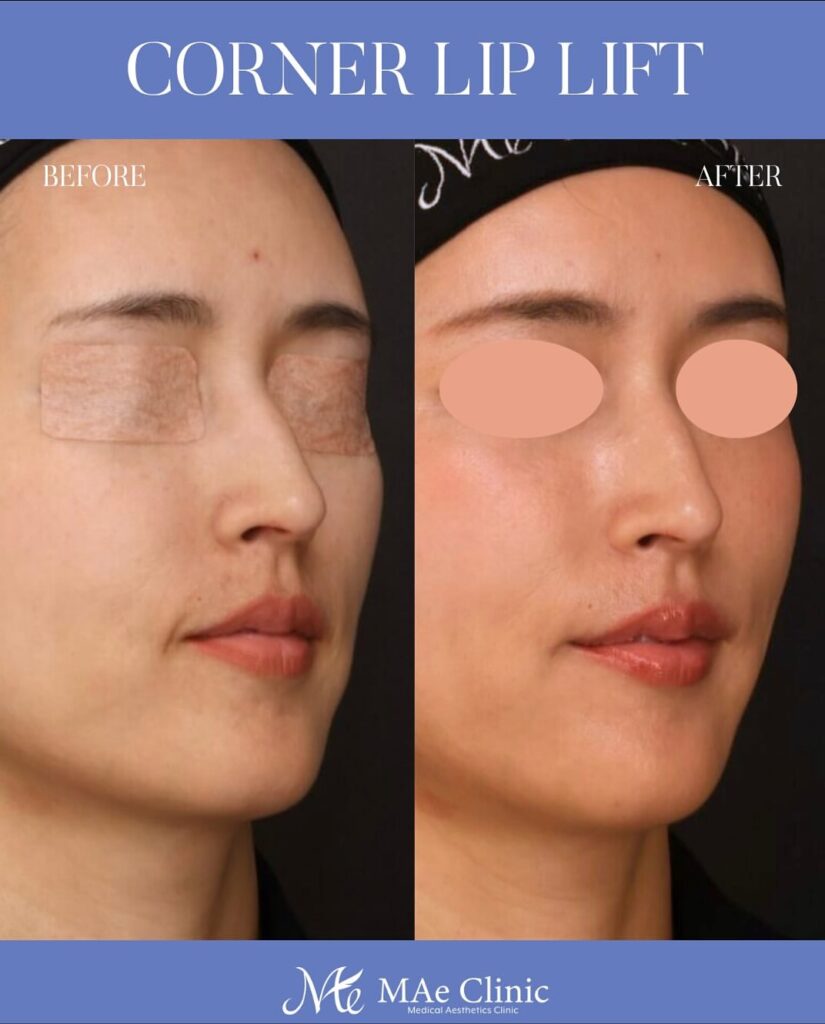 口角挙上術 木下恵里沙医師症例写真