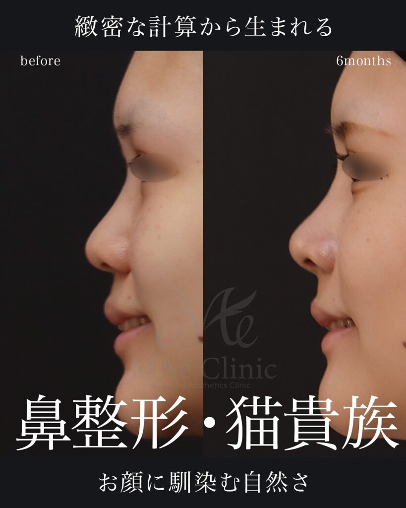 鼻中隔延長(肋軟骨)
鼻尖形成
鼻尖軟骨移植
隆鼻術(肋軟骨)
猫貴族手術(肋軟骨)
顎形成術(肋軟骨)
術後6ヵ月
前田翔医師症例