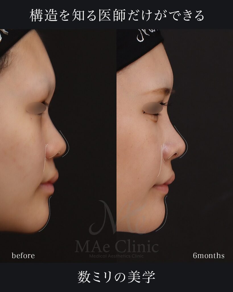 鼻中隔延長(肋軟骨) 鼻尖形成 鼻尖軟骨移植 隆鼻術(肋軟骨) 猫貴族手術(肋軟骨) 顎形成術(肋軟骨) 術後6ヵ月 前田翔医師症例