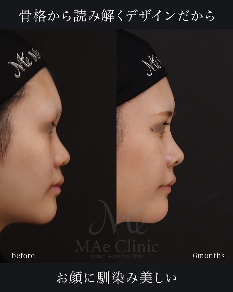 鼻中隔延長(肋軟骨) 鼻尖形成 鼻尖軟骨移植 隆鼻術(肋軟骨) 猫貴族手術(肋軟骨) 顎形成術(肋軟骨) 術後6ヵ月 前田翔医師症例