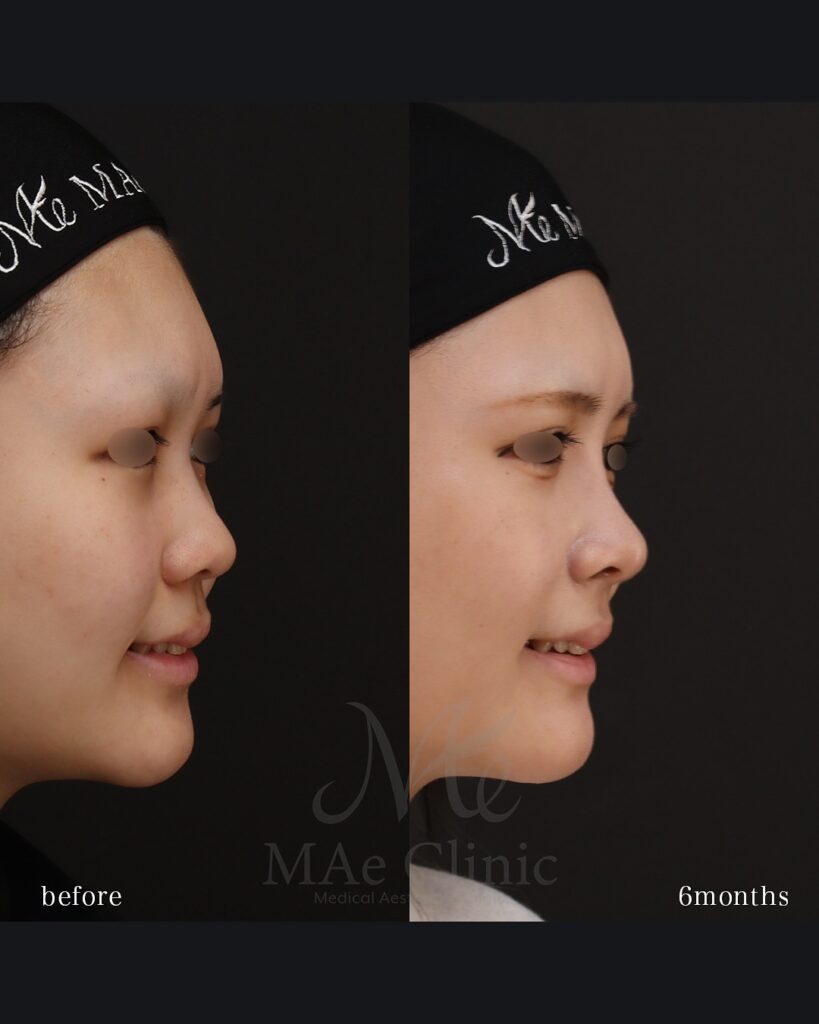 鼻中隔延長(肋軟骨) 鼻尖形成 鼻尖軟骨移植 隆鼻術(肋軟骨) 猫貴族手術(肋軟骨) 顎形成術(肋軟骨) 術後6ヵ月 前田翔医師症例