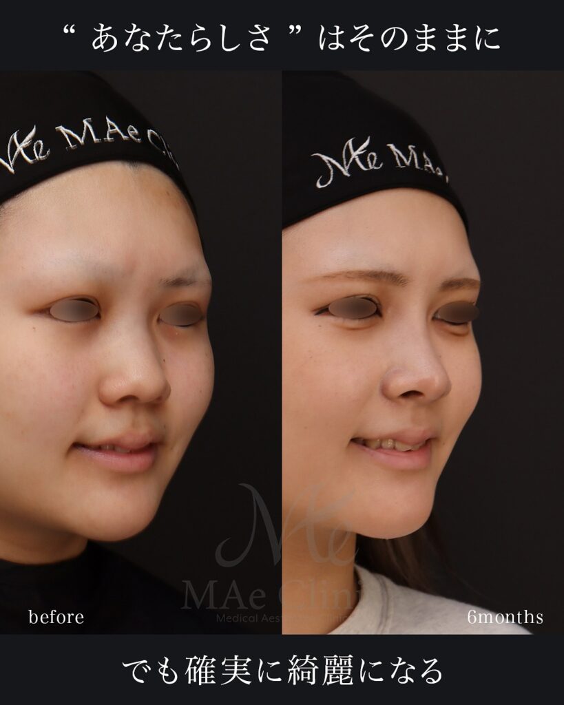 鼻中隔延長(肋軟骨) 鼻尖形成 鼻尖軟骨移植 隆鼻術(肋軟骨) 猫貴族手術(肋軟骨) 顎形成術(肋軟骨) 術後6ヵ月 前田翔医師症例