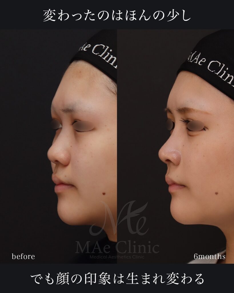 鼻中隔延長(肋軟骨) 鼻尖形成 鼻尖軟骨移植 隆鼻術(肋軟骨) 猫貴族手術(肋軟骨) 顎形成術(肋軟骨) 術後6ヵ月 前田翔医師症例