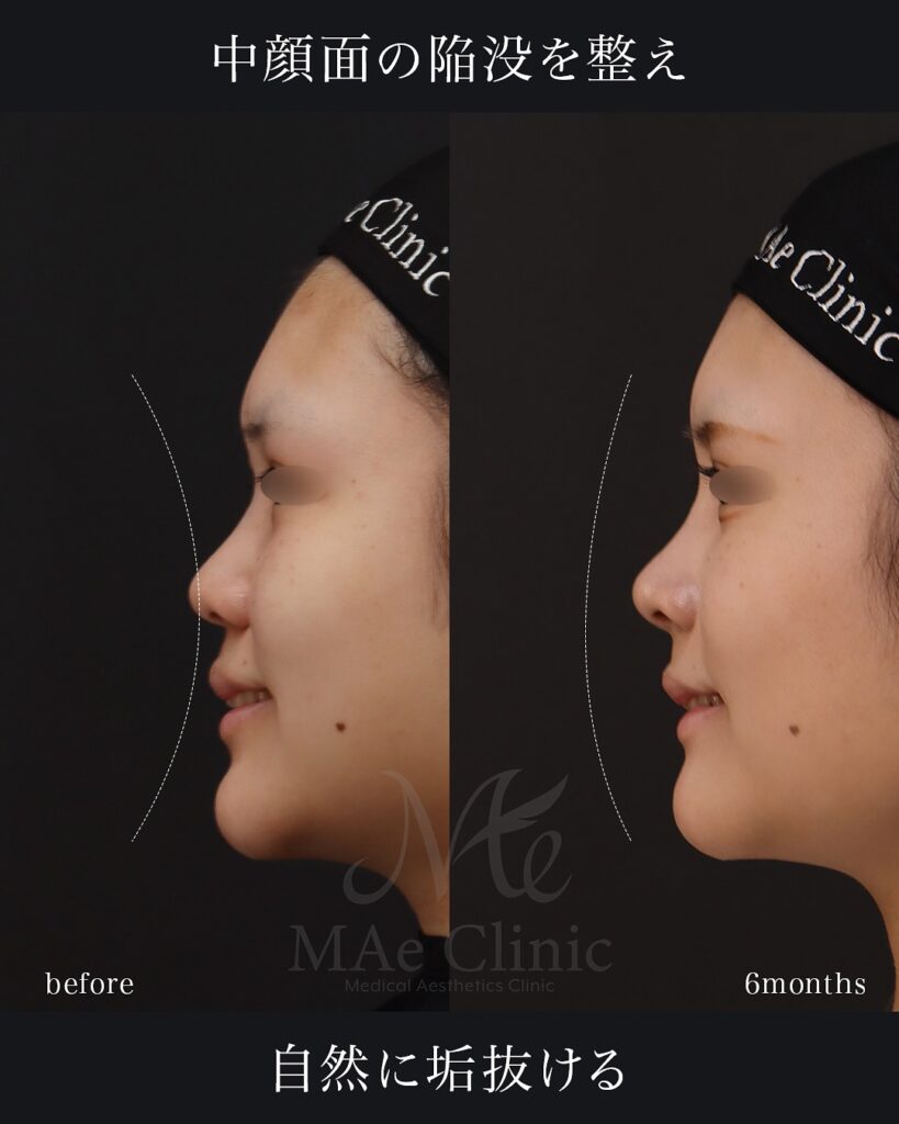 鼻中隔延長(肋軟骨) 鼻尖形成 鼻尖軟骨移植 隆鼻術(肋軟骨) 猫貴族手術(肋軟骨) 顎形成術(肋軟骨) 術後6ヵ月 前田翔医師症例