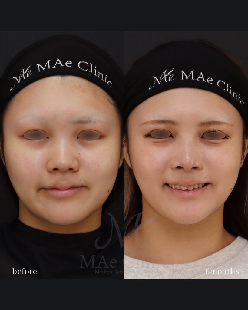 鼻中隔延長(肋軟骨) 鼻尖形成 鼻尖軟骨移植 隆鼻術(肋軟骨) 猫貴族手術(肋軟骨) 顎形成術(肋軟骨) 術後6ヵ月 前田翔医師症例