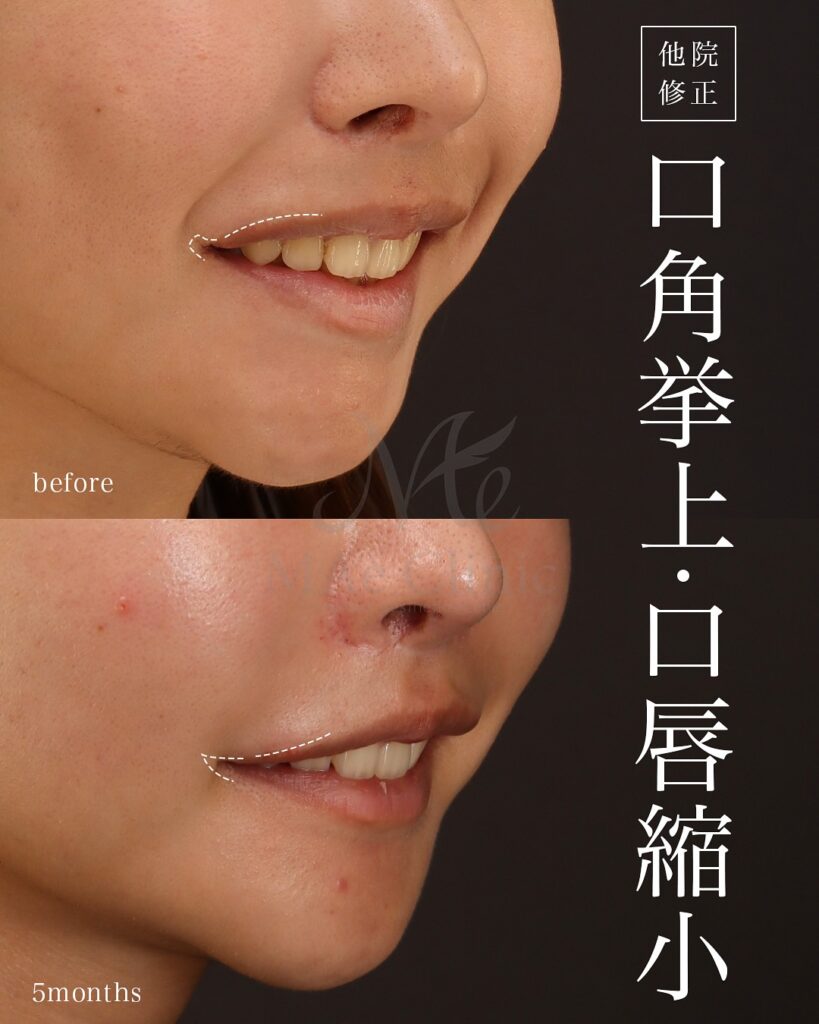 口角挙上 口唇縮小(上) 術後5ヵ月 前田翔医師症例写真