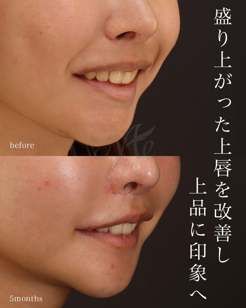 口角挙上 口唇縮小(上) 術後5ヵ月 前田翔医師症例写真