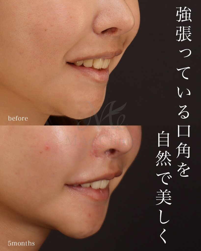 口角挙上 口唇縮小(上) 術後5ヵ月 前田翔医師症例写真