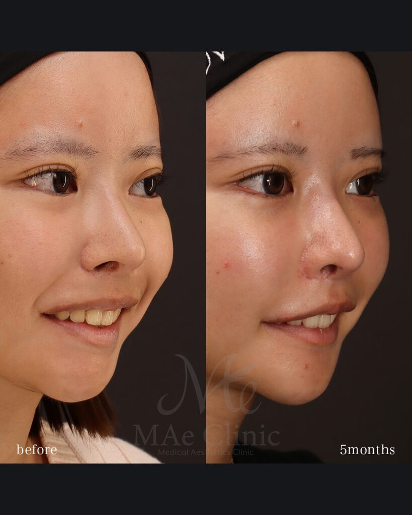 口角挙上 口唇縮小(上) 術後5ヵ月 前田翔医師症例写真