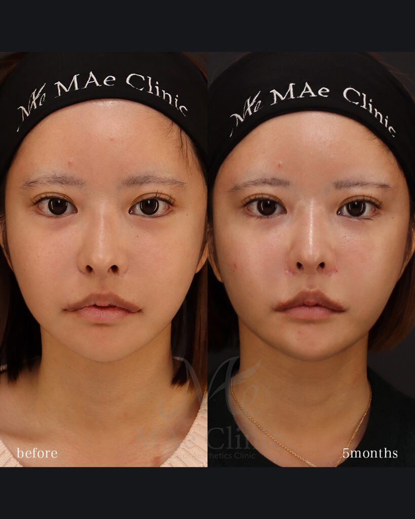 口角挙上 口唇縮小(上) 術後5ヵ月 前田翔医師症例写真
