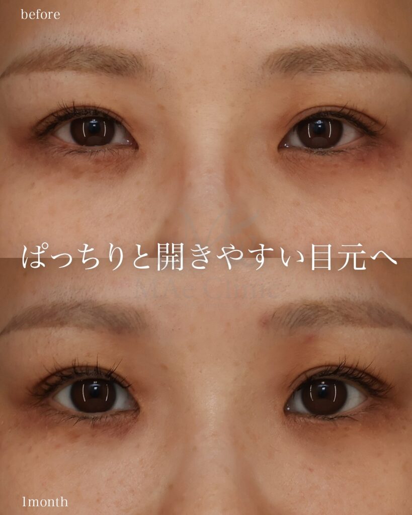 前額リフト 前田翔医師症例