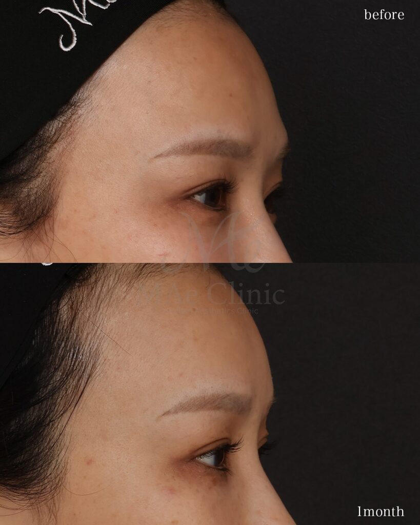 前額リフト 前田翔医師症例