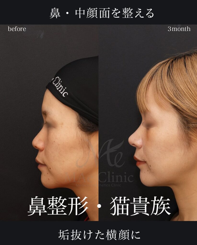 鼻中隔延長
鼻尖形成
鼻尖軟骨移植
猫貴族手術（肋軟骨）

望月正人医師症例