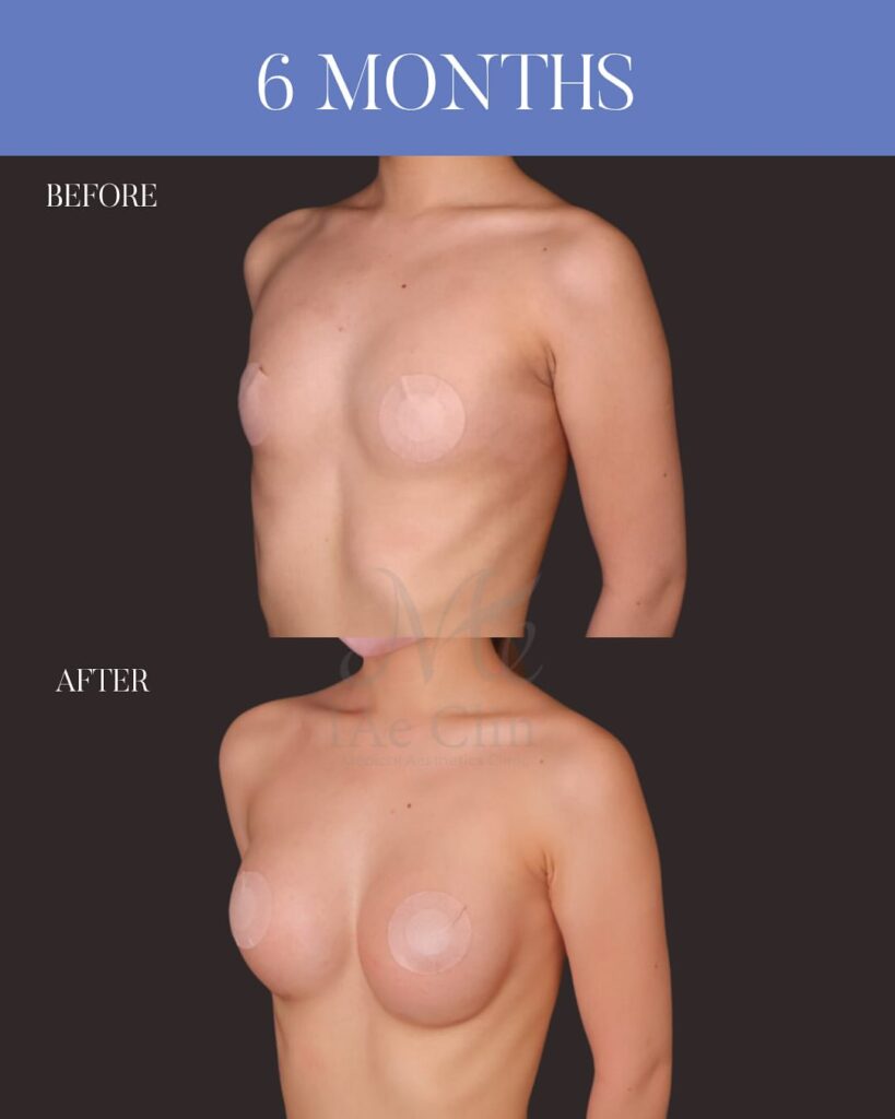 シリコンバッグ豊胸 Motiva Ergonomix2 250cc 乳腺下留置 乳房下溝切開 木下恵里沙医師症例