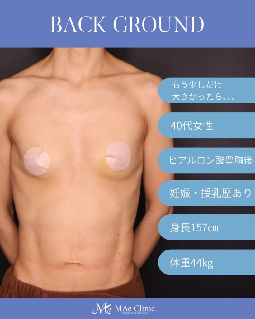 脂肪注入豊胸 木下恵里沙医師症例