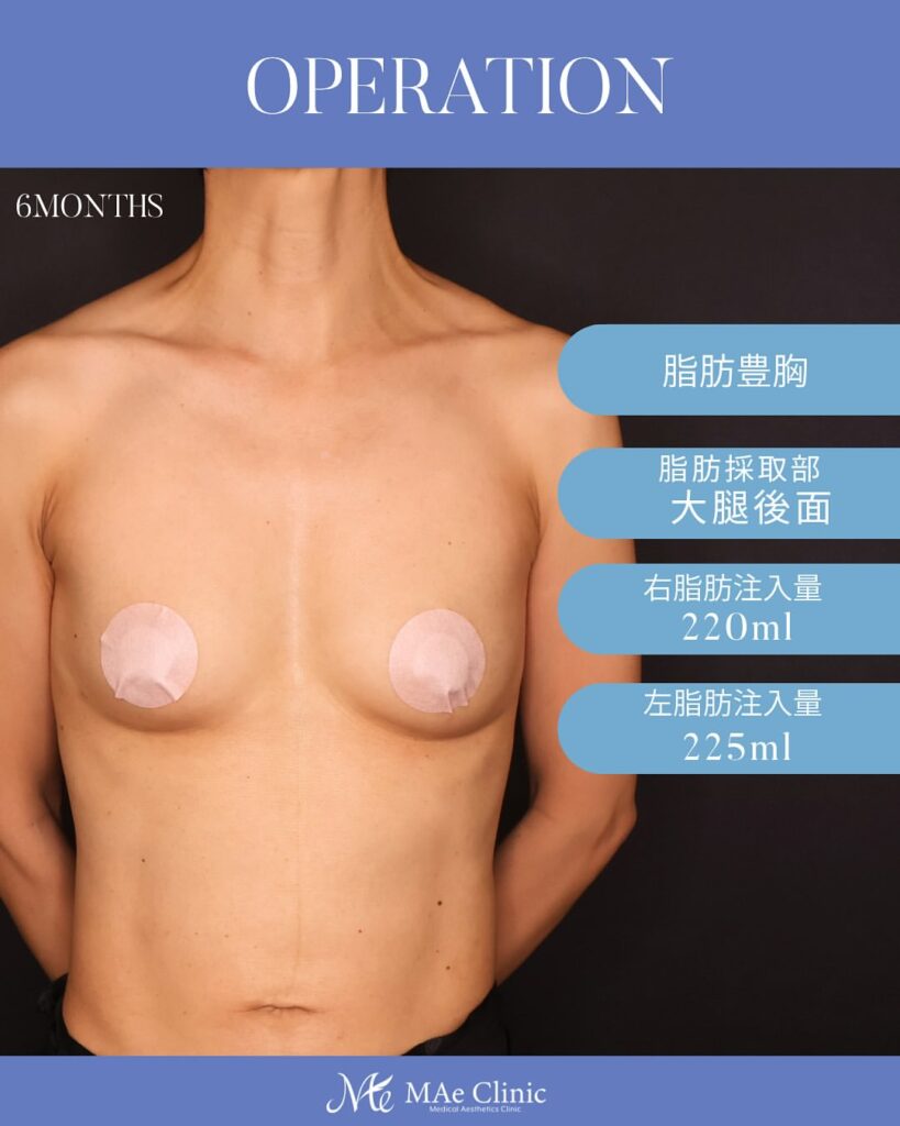 脂肪注入豊胸 木下恵里沙医師症例