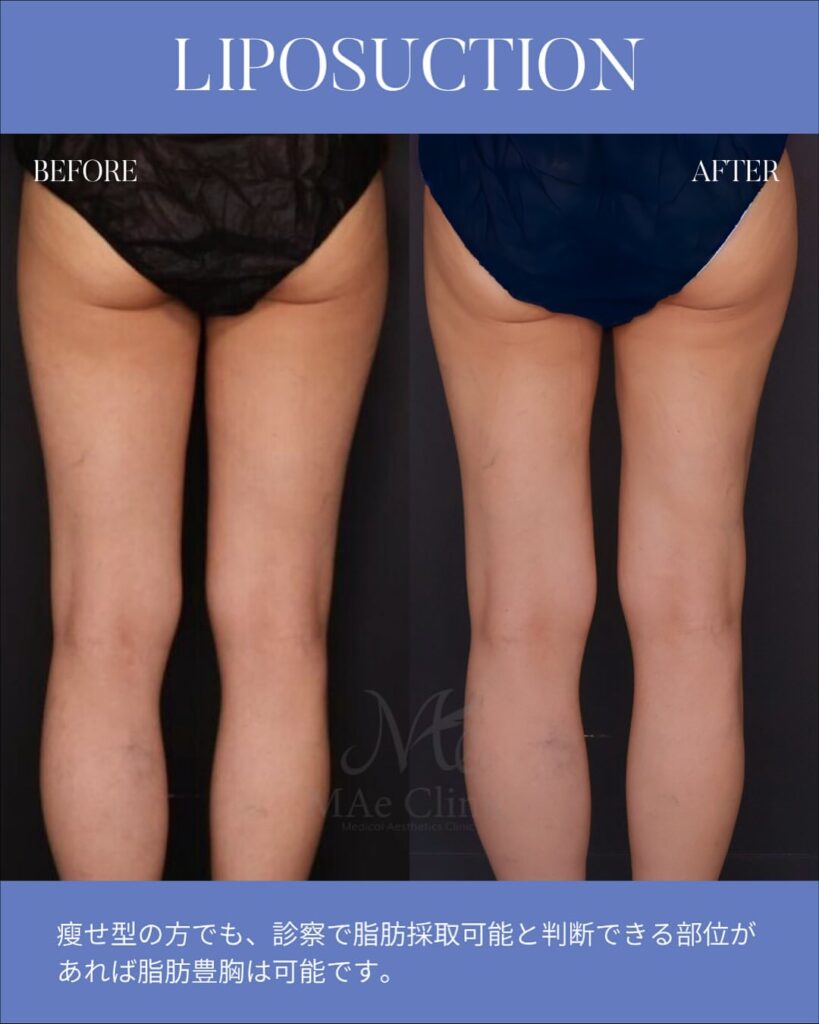 脂肪注入豊胸 木下恵里沙医師症例