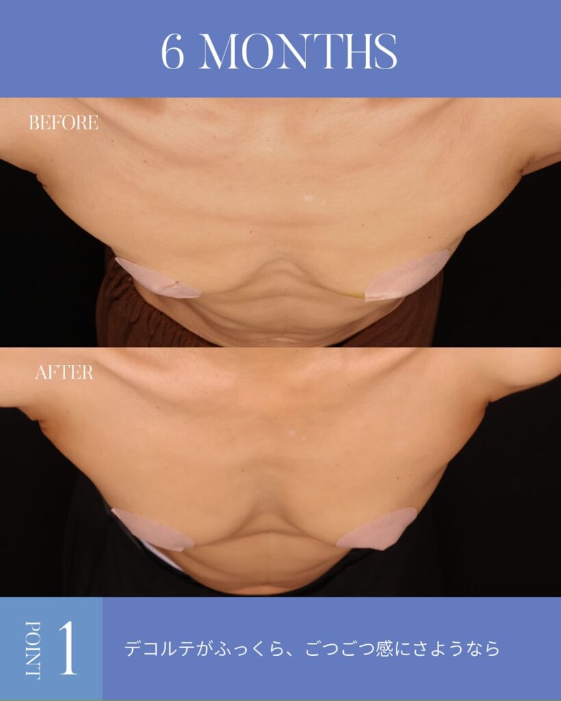脂肪注入豊胸 木下恵里沙医師症例