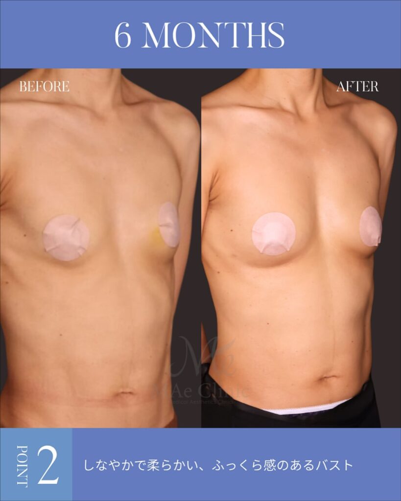 脂肪注入豊胸 木下恵里沙医師症例