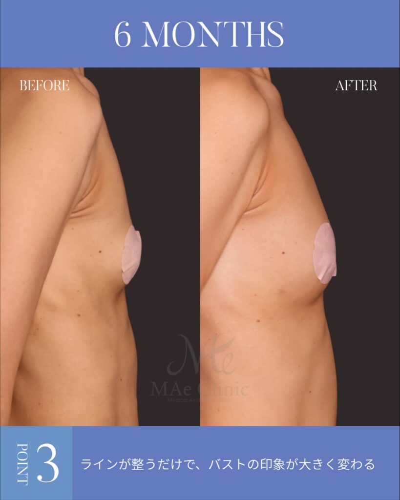 脂肪注入豊胸 木下恵里沙医師症例