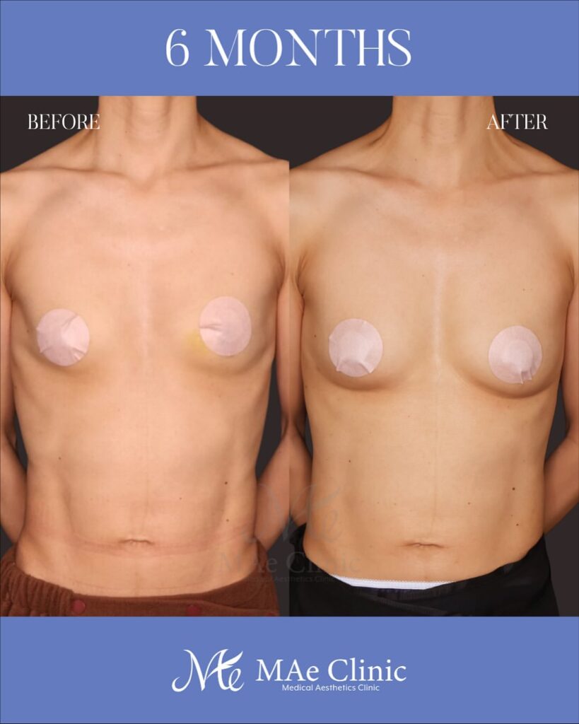 脂肪注入豊胸 木下恵里沙医師症例