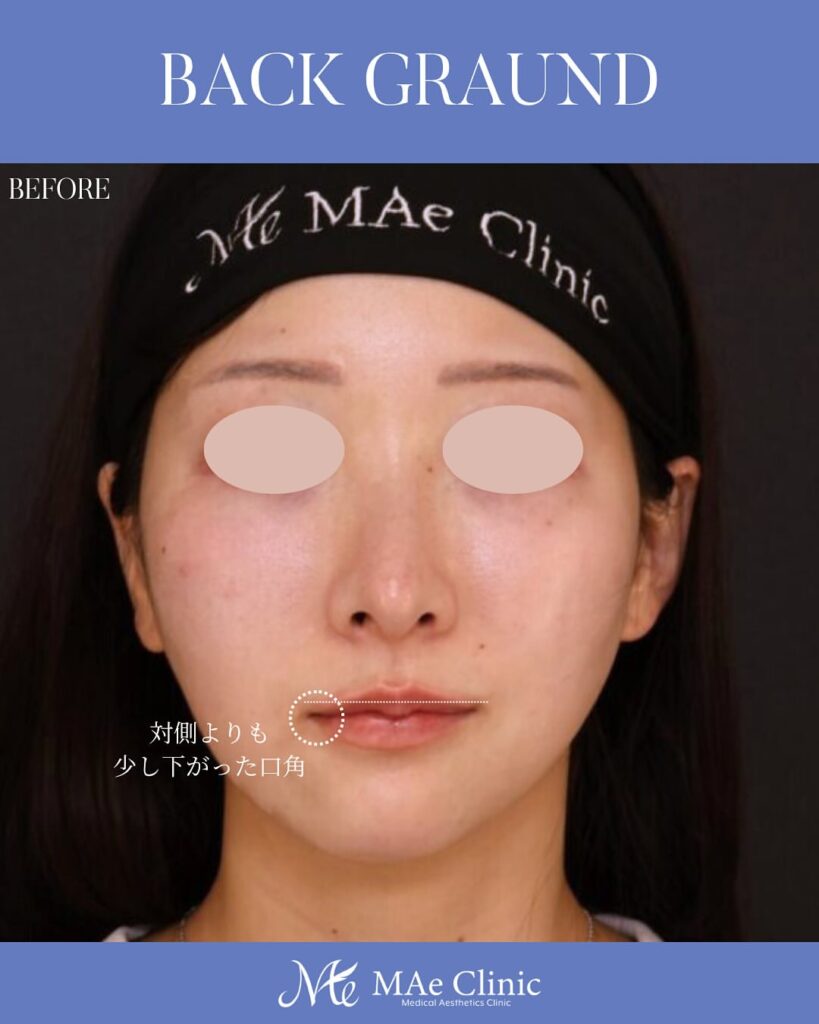 口角挙上 木下恵里沙医師症例