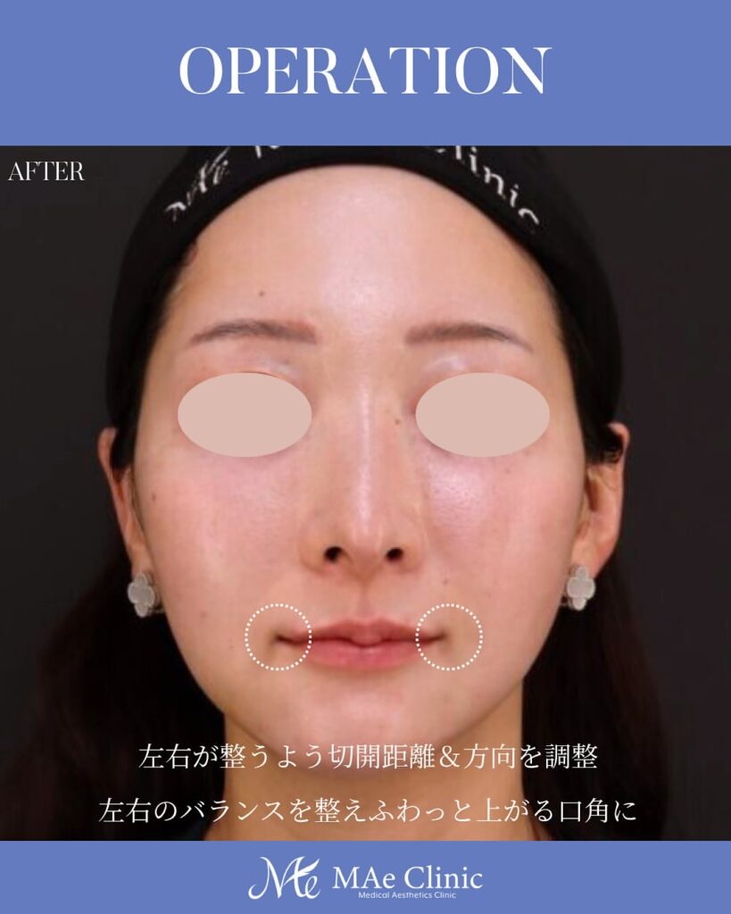 口角挙上 木下恵里沙医師症例