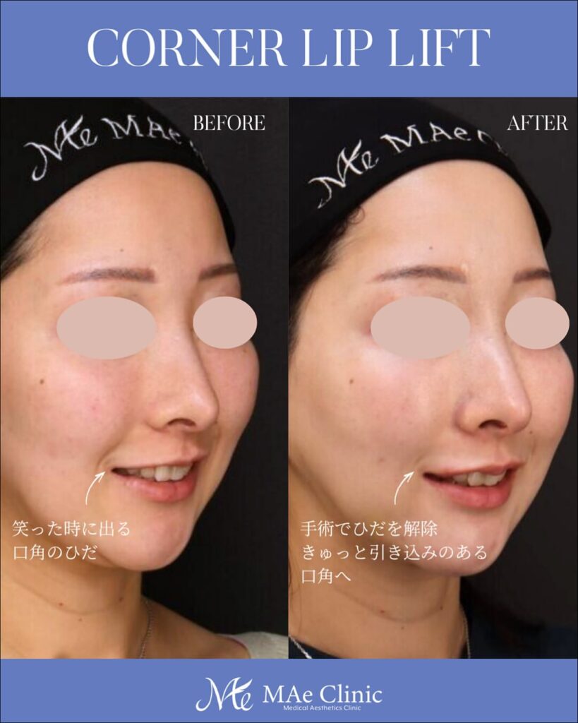 口角挙上 木下恵里沙医師症例