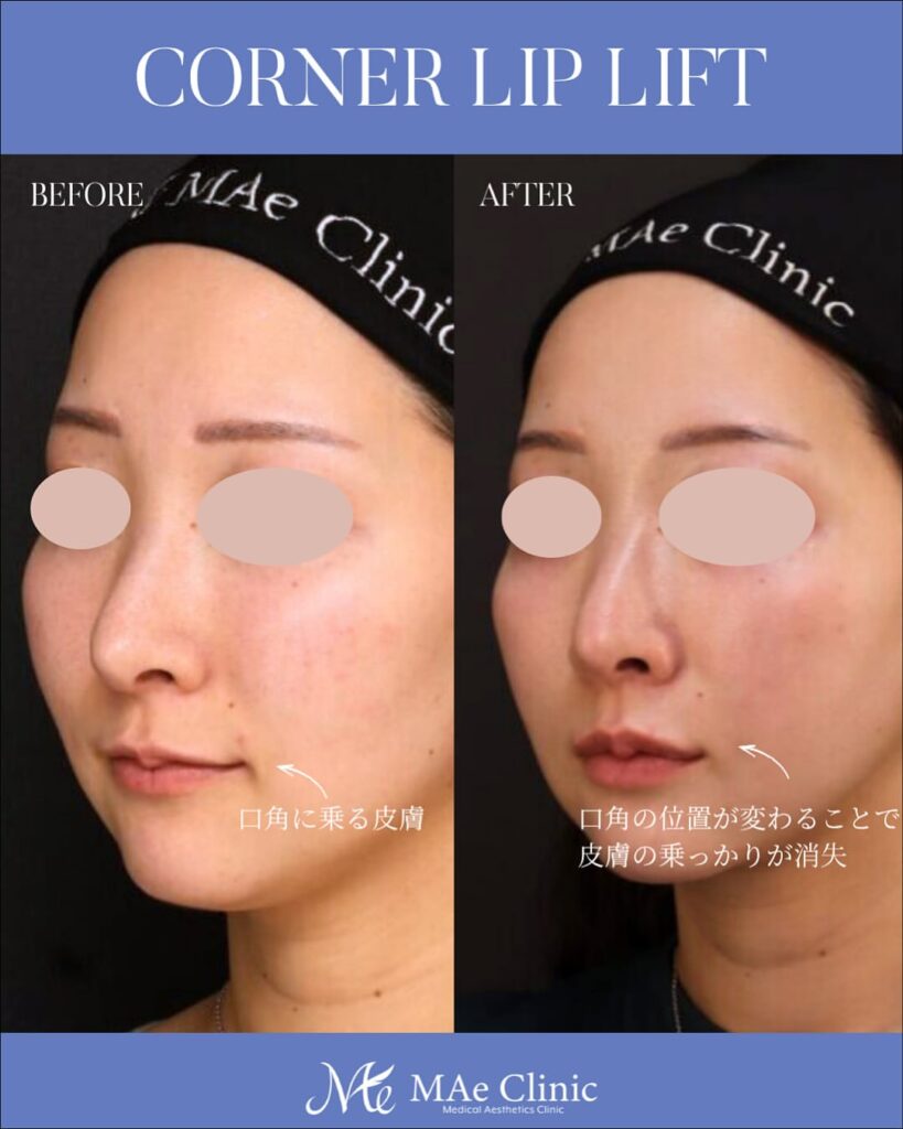 口角挙上 木下恵里沙医師症例