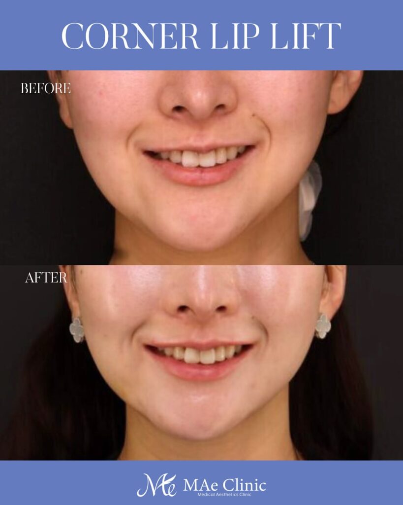 口角挙上 木下恵里沙医師症例